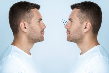 The Incredible Evolution of Nose Enhancements: Then vs. Now
